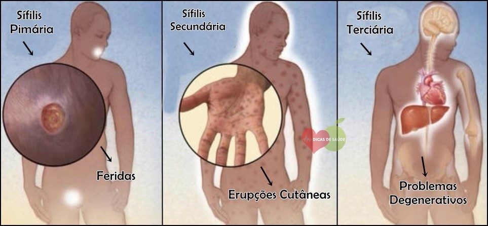 Sífilis Causas, Sintomas e Tratamentos | Dicas de Saúde