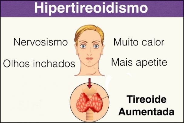 Hipertireoidismo O Que Causas Sintomas E Tratamento Dicas De Sa De