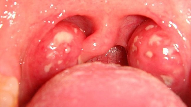 Dor de garganta
