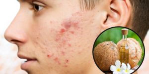 Óleo de coco Para Tratar Acne