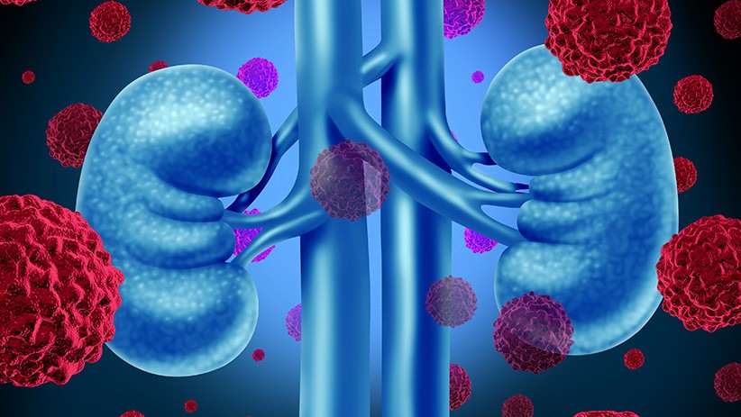 Sintomas do Câncer de Rim