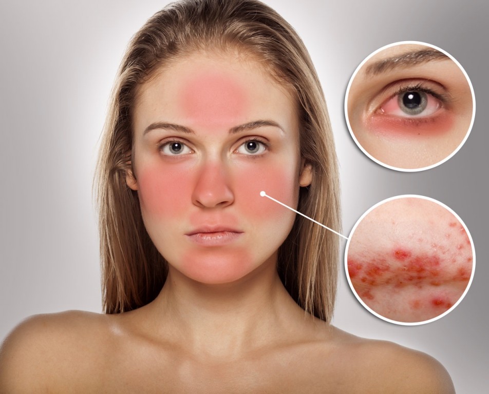 10 remedios caseiros para tratar rosacea