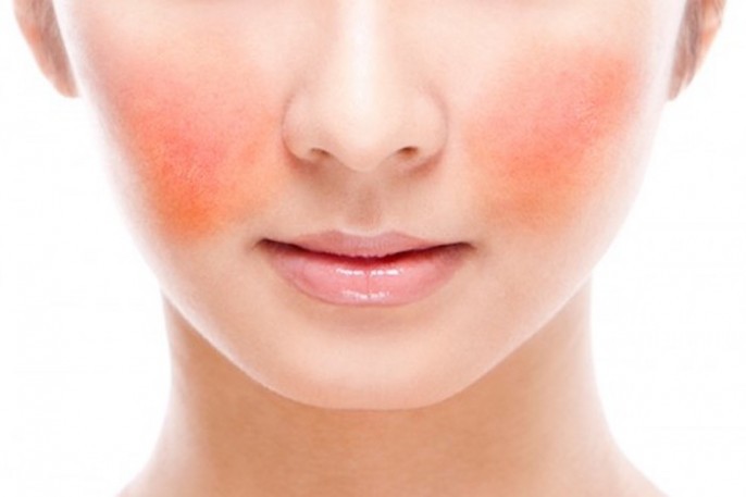 10-remedios-caseiros-para-tratar-rosacea