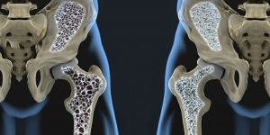 os-15-remedios-caseiros-para-osteoporose-2