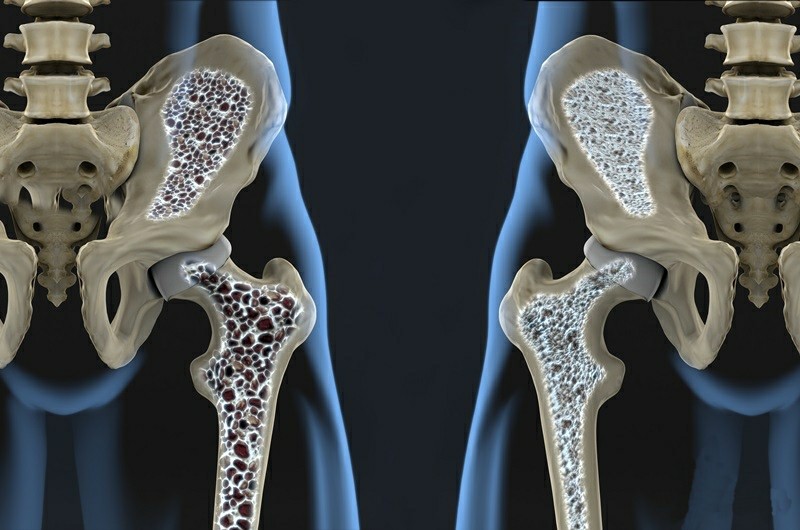 os-15-remedios-caseiros-para-osteoporose-2