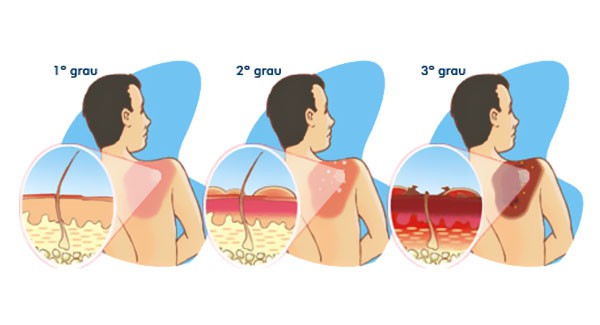 queimaduras