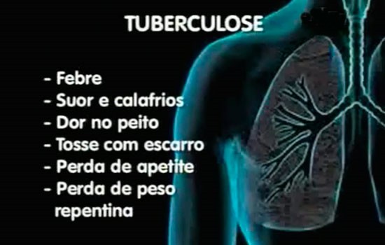 tuberculose-remedios