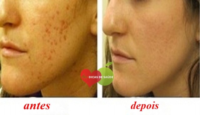 Acne Como se Livrar Naturalmente 1