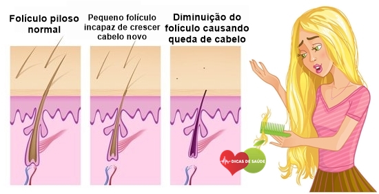 Dicas de Como evitar a Queda de Cabelo 1