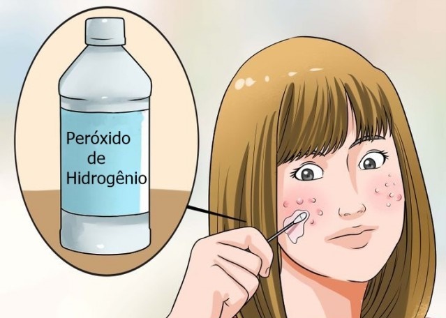 Peróxido de Hidrogênio Para Tratar a Acne