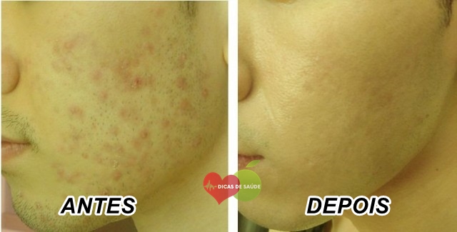 remedios-caseiros-para-cicatrizes-da-acne