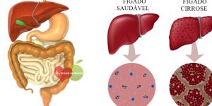 Sintomas da Insuficiência Hepática