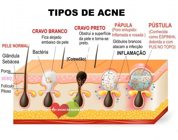 Acabar de Vez com Espinhas