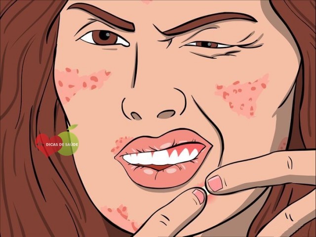 acne-cistica-como-eliminar