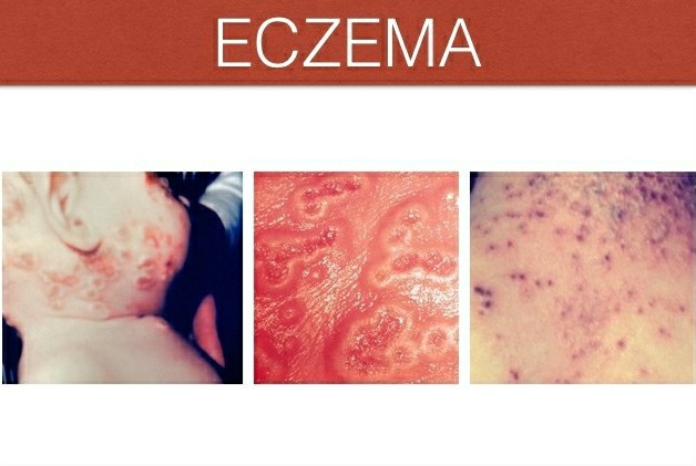 Como usar o Vinagre de Maçã Para Eczema