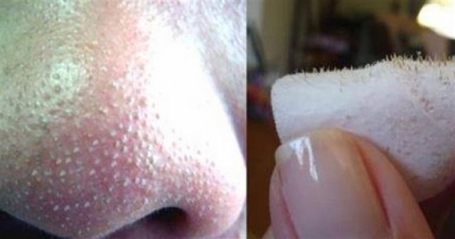 como-usar-agua-oxgenada-para-remover-cravos