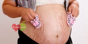 10 passos para se livrar das estrias durante a gravidez