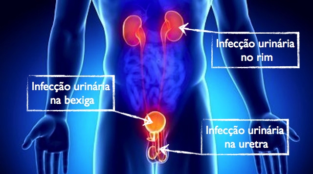 infeccao-urinaria-4