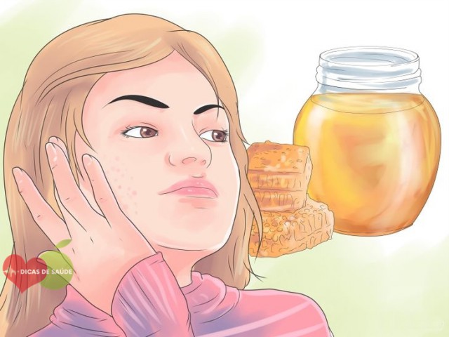 Como Usar o Mel Para Tratar Acne em Casa