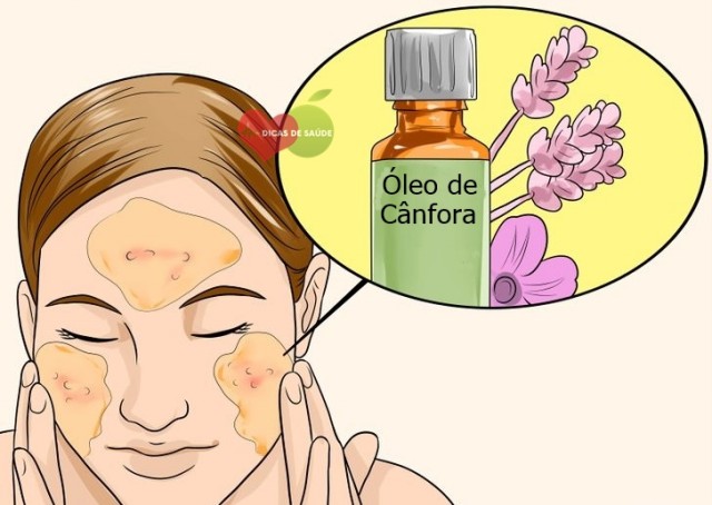 oleo de canfora para acne