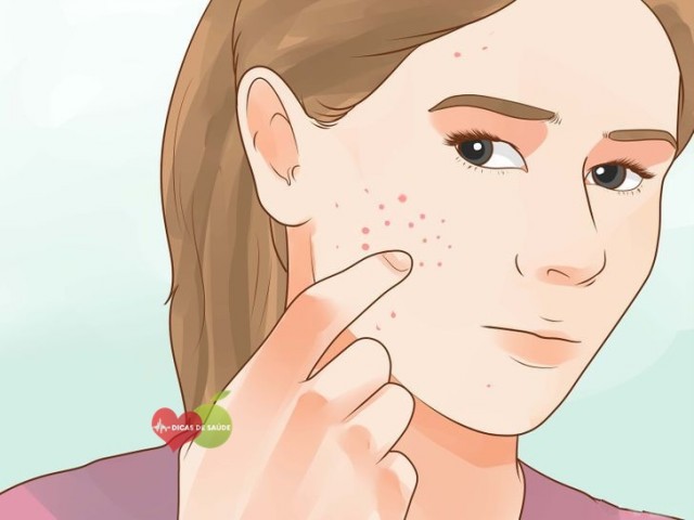 vitamina e para acne