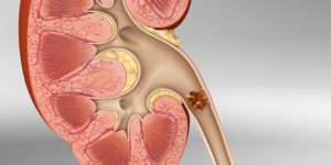 os-remedios-caseiros-para-tratar-calculo-renal-1