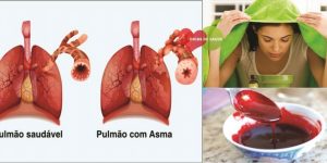 remedios-caseiros-para-aliviar-a-asma-2