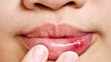 Os 15 Remédios Caseiros Para Tratar Aftas de Forma Natural | Dicas de Saúde