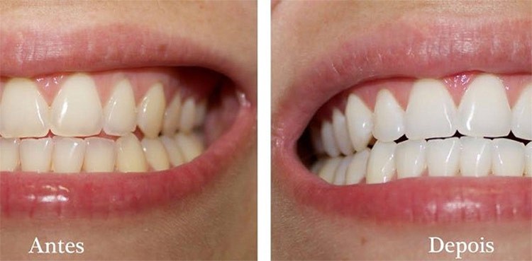 Como Clarear os Dentes
