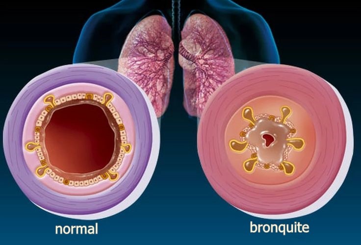 Remédios Caseiros Para Tratar Bronquite