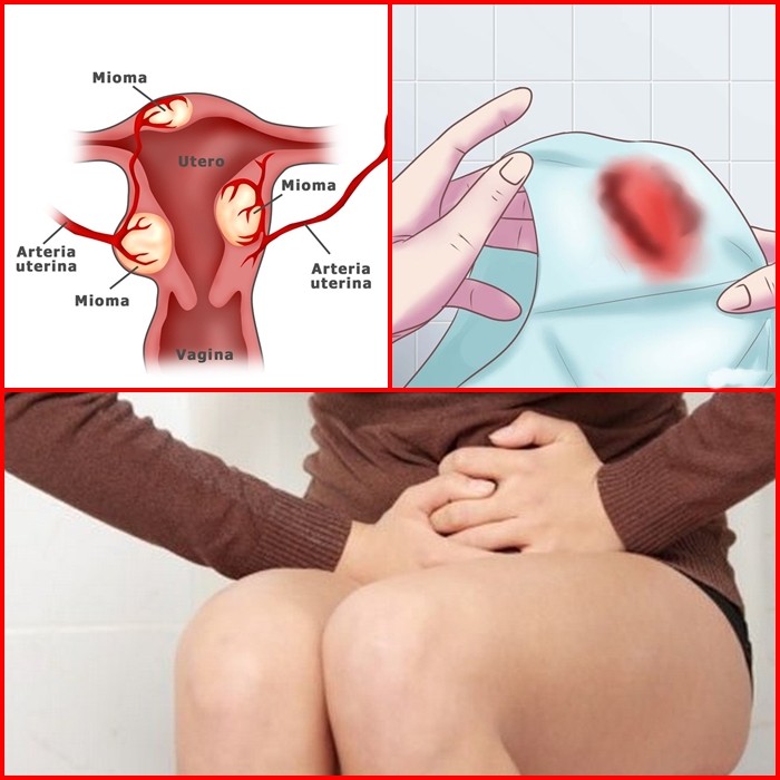 fibroma-uterino-sintomas-tratamentos-e-causas