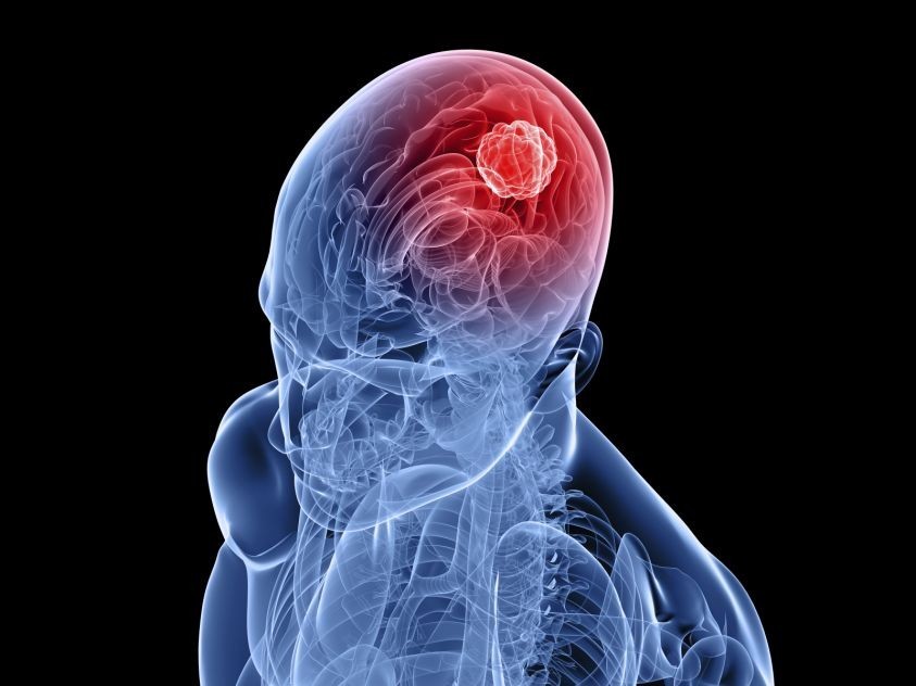 Sintomas de Tumor no Cérebro