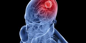Sintomas de Tumor no Cérebro