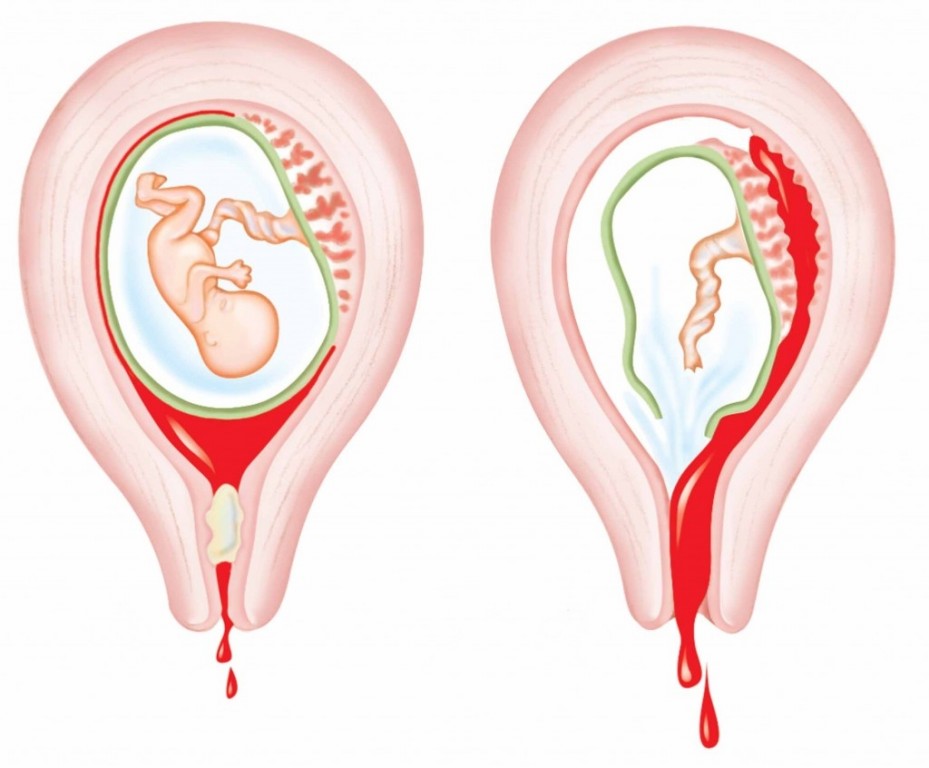 Aborto Espontâneo Causas Sintomas e Tratamentos