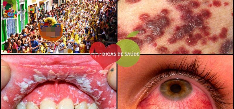 As 10 Doenças que Você Pode Contrair no Carnaval