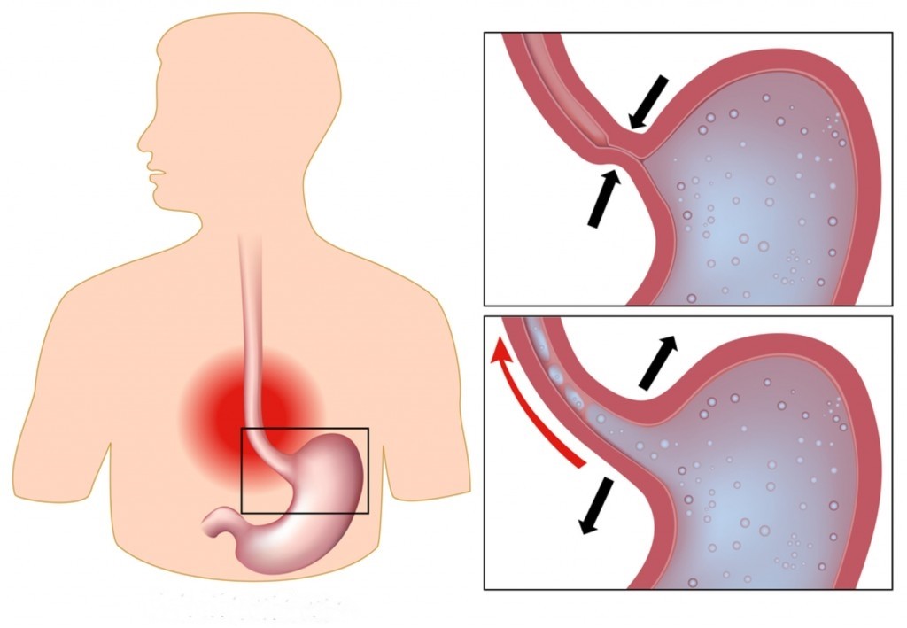 Azia e Refluxo