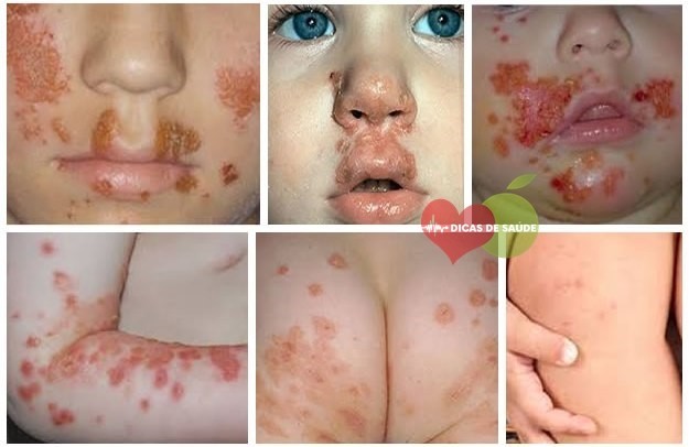 Impetigo Causas