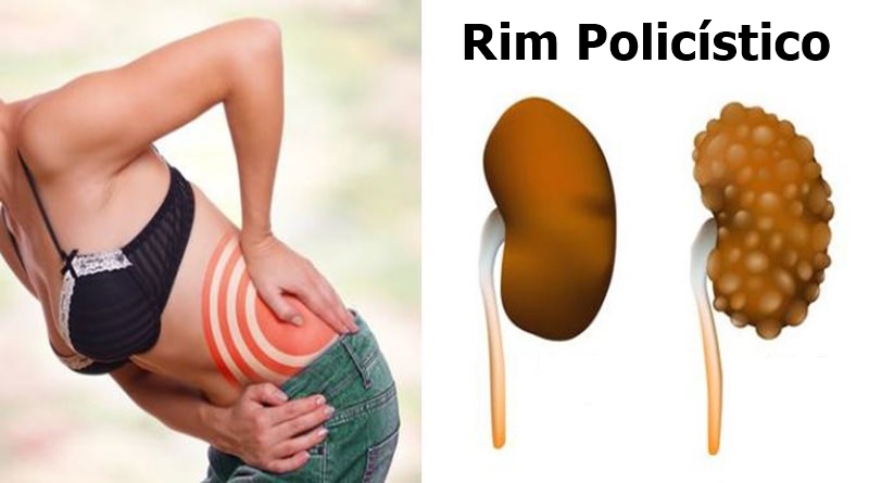 Rim Policístico