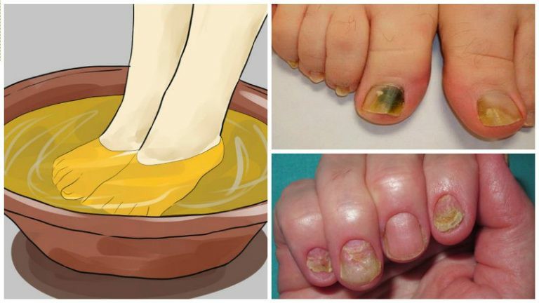 3 Ingredientes que Acabam com os Fungos nas Unhas Para Sempre