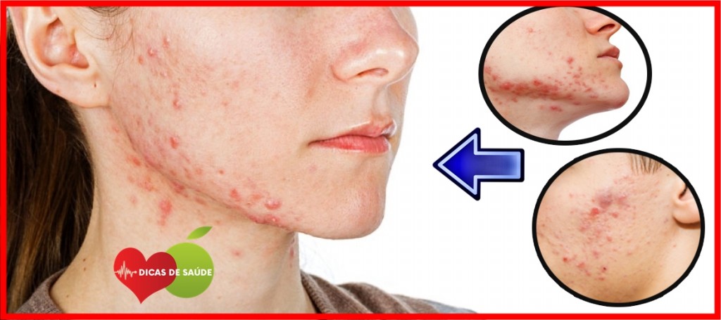 As 8 Dicas Para Acabar com as Acne