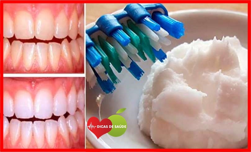 Como Clarear os Dentes Naturalmente