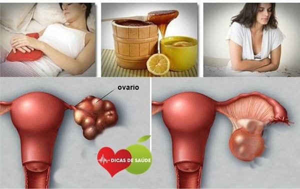 Como Limpar e Remover os Cisto de Ovario com essa Simples Receita