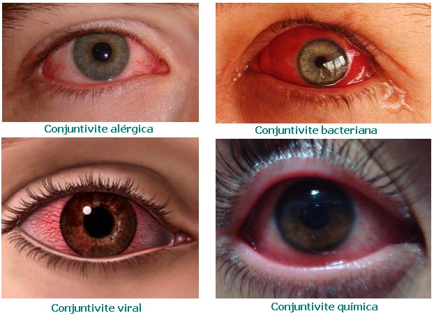 Conjuntivite Conjuntivite