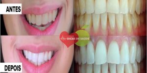 Dentes Brancos em 3 Semanas com Esta Receita
