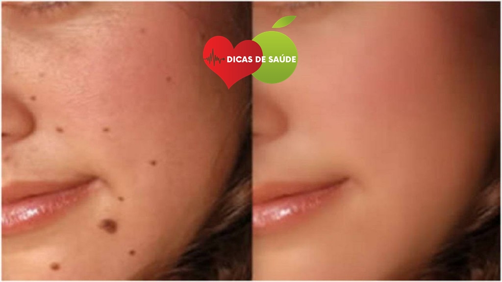 Elimine as Verrugas as Manchas e as Acnes Fazendo isso a Noite 1