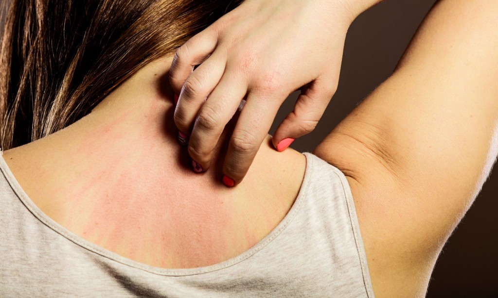 Sintomas e Tratamentos Para Alergias Da Pele Seca 