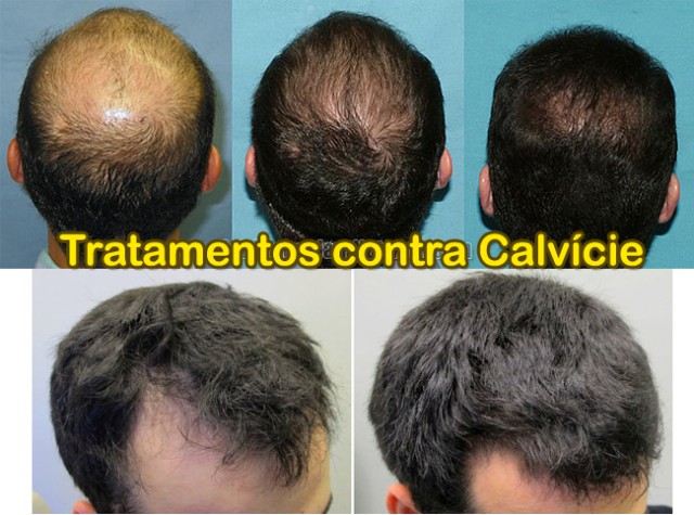 calvicie tratamentos