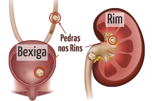 pedras nos rins