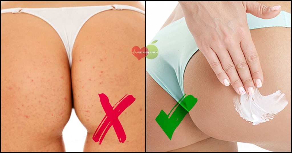 As 10 Maneiras de Eliminar a Acnes do Bumbum Naturalmente