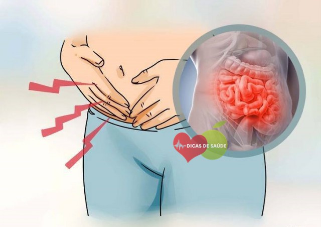 Cólica Intestinal – Causas, Sintomas e Tratamentos | Dicas de Saúde
